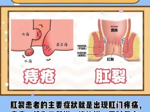 肛门拳交_什么是肛门拳交？有什么风险？